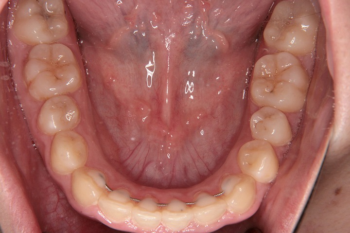 症例紹介 矯正歯科 大阪 ほてい矯正歯科