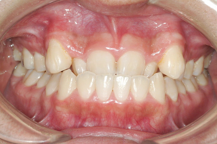 症例紹介 矯正歯科 大阪 ほてい矯正歯科