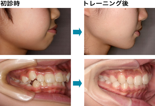 口唇 舌トレーニング Mrcシステム 治療内容のご紹介 矯正歯科を大阪でお探しなら ほてい矯正歯科