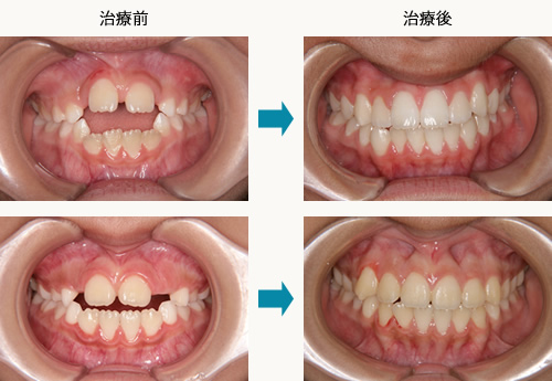 口唇 舌トレーニング Mrcシステム 治療内容のご紹介 矯正歯科を大阪でお探しなら ほてい矯正歯科