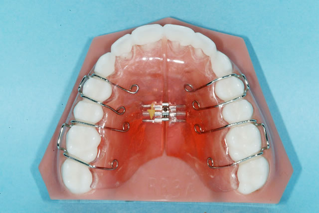 可撤式装置 各種矯正装置 治療内容のご紹介 矯正歯科を大阪でお探しなら ほてい矯正歯科