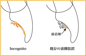 Incognitoと既存の裏側装置の比較