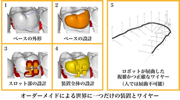 オーダーメイドによる世界に一つだけの装置とワイヤー